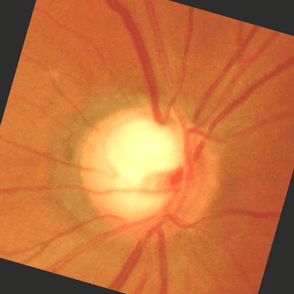Retinal fundus image for glaucoma screening