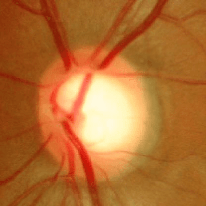 Retinal fundus image, normal eye.