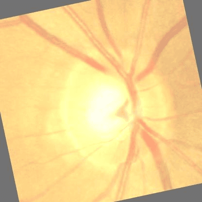 Retinal fundus image, early glaucoma.